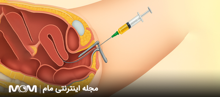 انتقال جنین در IVF