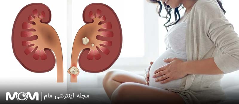 سنگ کلیه در بارداری