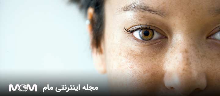 ملاسما در بارداری