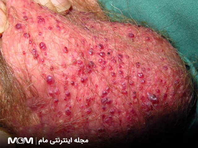 ضایعات پوستی شبیه زگیل تناسلی - آنژیوکراتوم