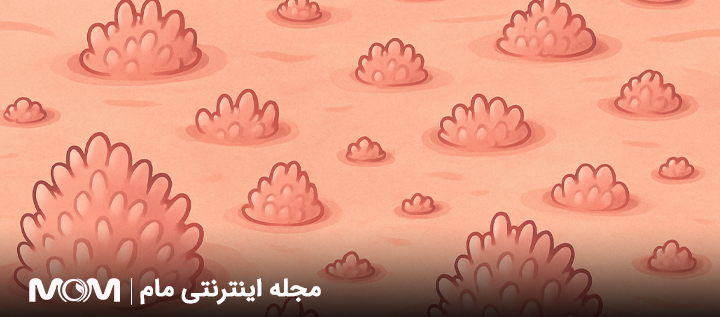 ضایعات پوستی شبیه زگیل تناسلی