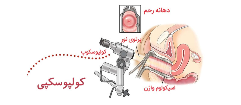 کولپوسکوپی