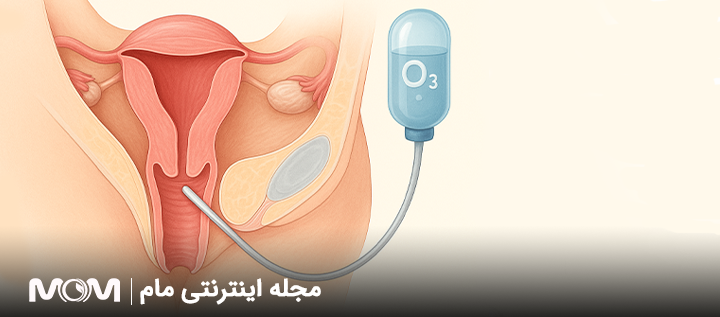 اوزون تراپی واژن