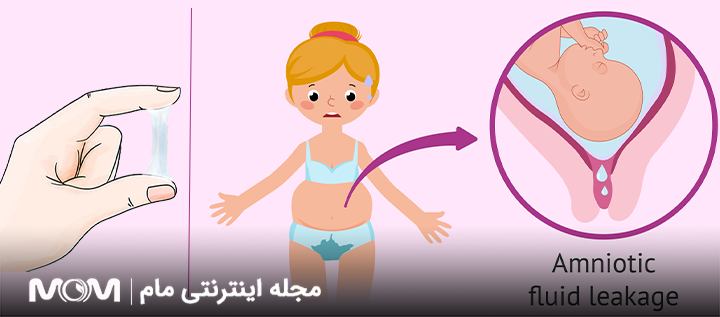تفاوت آبریزش با ترشح در بارداری
