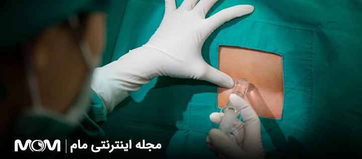 زایمان اپیدورال چیست