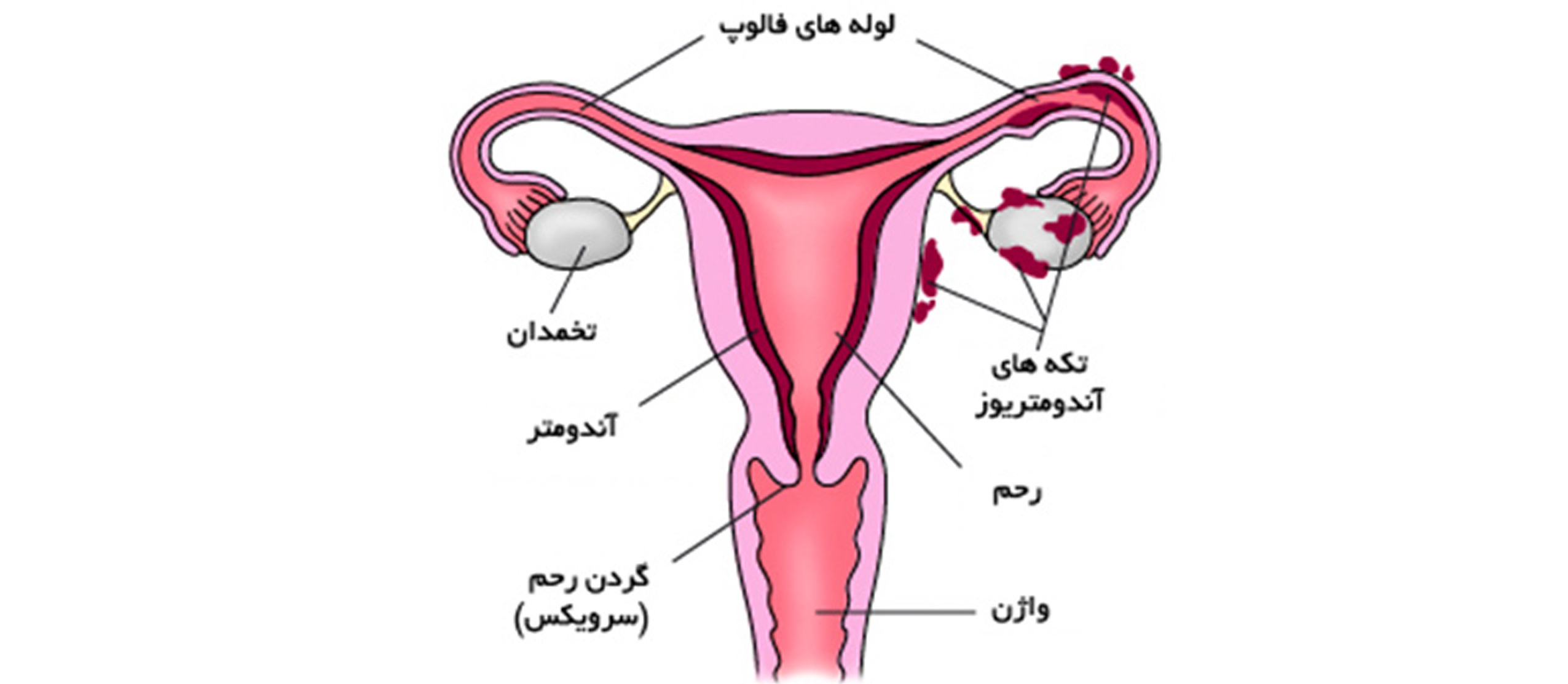 اندومتریوز | دکتر آمنه لاهوتی اشکوری