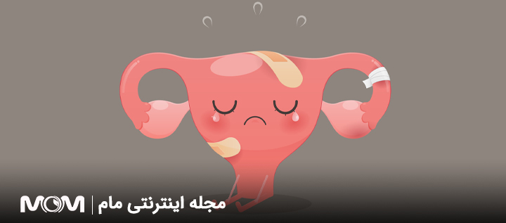 تورشن تخمدان چیست؟
