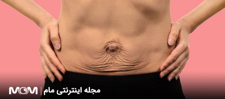 افتادگی پوست بعد از زایمان