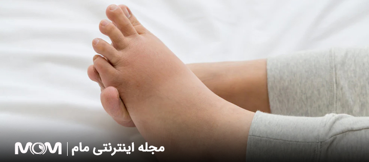 علت ورم پا بعد از زایمان