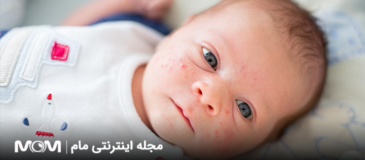 آکنه نوزادی