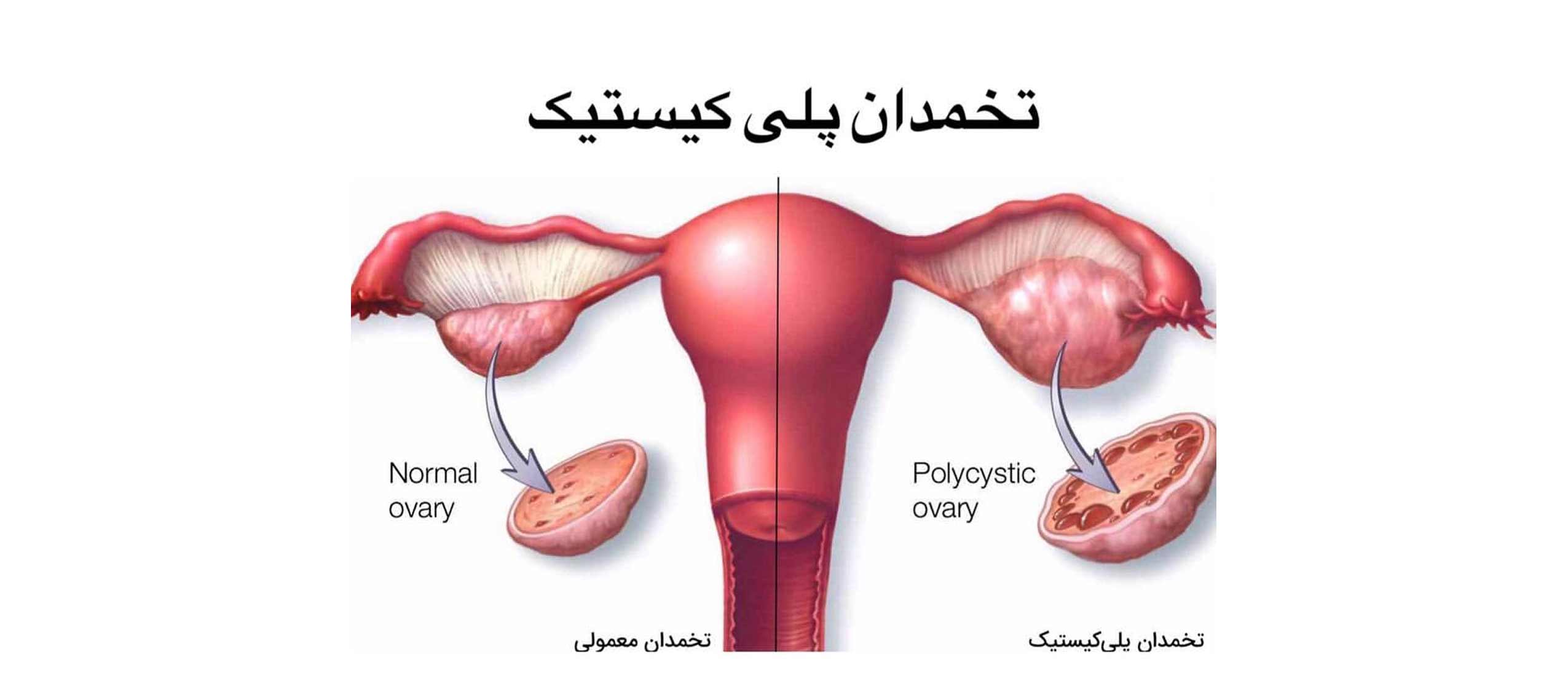 سندرم تخمدان پلی کیستیک | دکتر سیده معصومه قاضی میرسعید