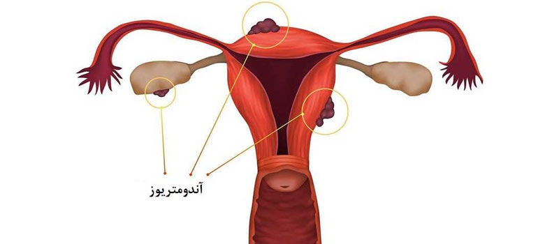 میکرواینجکشن در ناباروری به ‎دلیل اندومتریوز