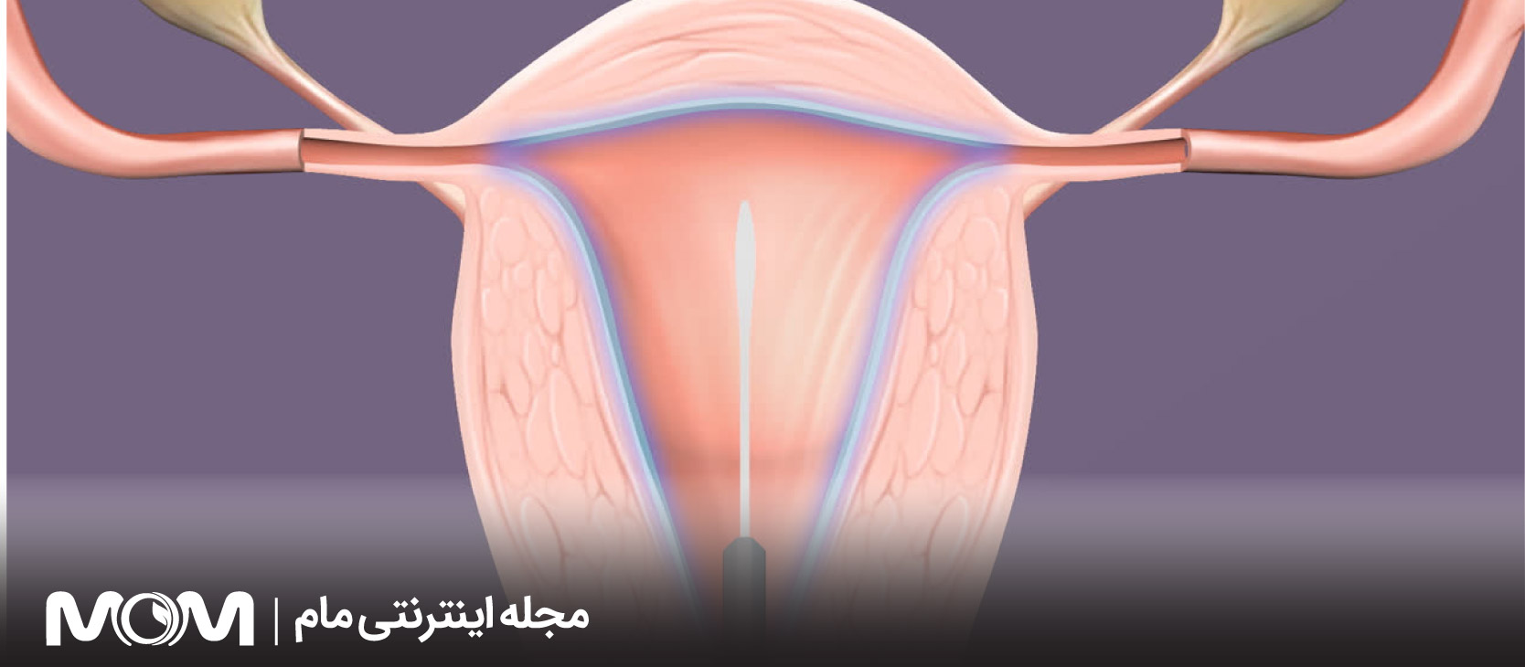 ابلیشن رحم