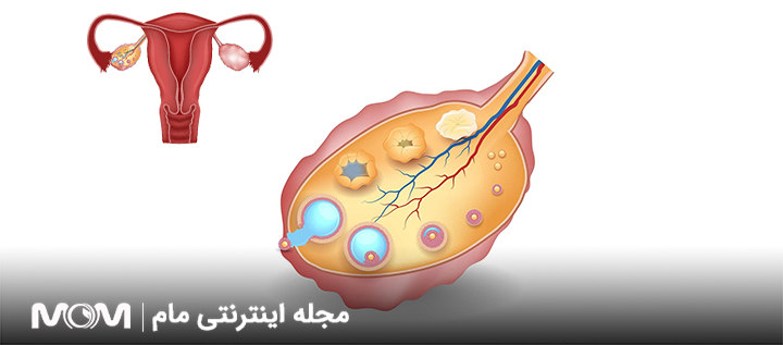 فولیکول چیست و آیا همان تخمک است؟