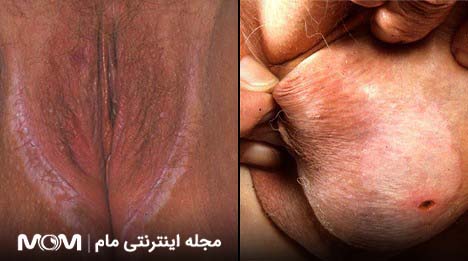 ضایعات پوستی شبیه زگیل تناسلی | لیکن اسکلروزیس