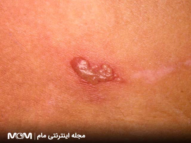 ضایعات پوستی شبیه زگیل تناسلی - تبخال تناسلی