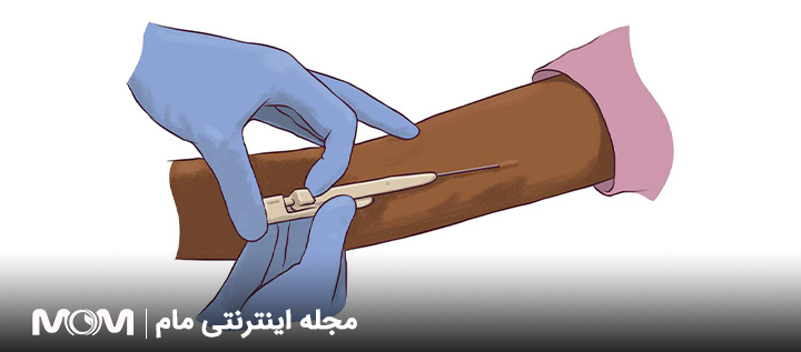 برداشتن ایمپلنت ضد بارداری