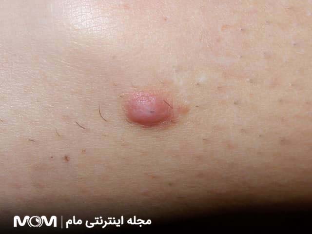 ضایعات پوستی شبیه زگیل تناسلی - فیبروما