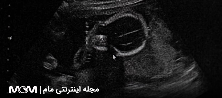 بارداری پوچ