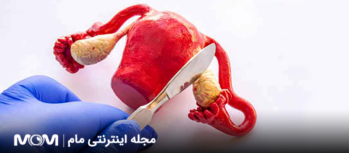 اوفورکتومی چیست