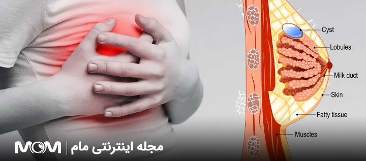 فیبروآدنوم پستان چیست؟