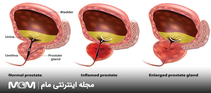 بزرگ شدن پروستات