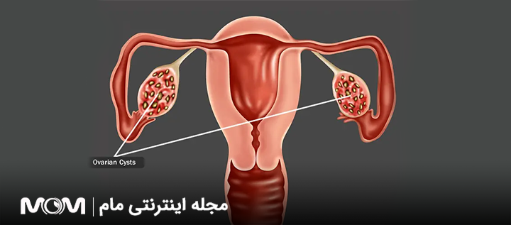 تخمدان چیست؟ ساختار و عملکرد و بیماری های تخمدان زنان