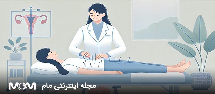 رفع تنبلی تخمدان با طب سوزنی