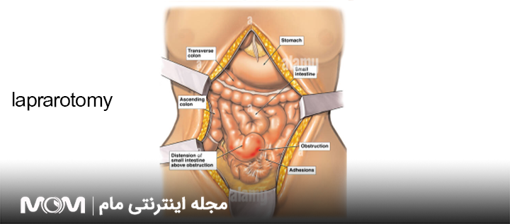 لاپاروتومی چیست و تفاوت آن با لاپاراسکوپی