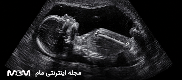 fl در سونوگرافی جنین چیست