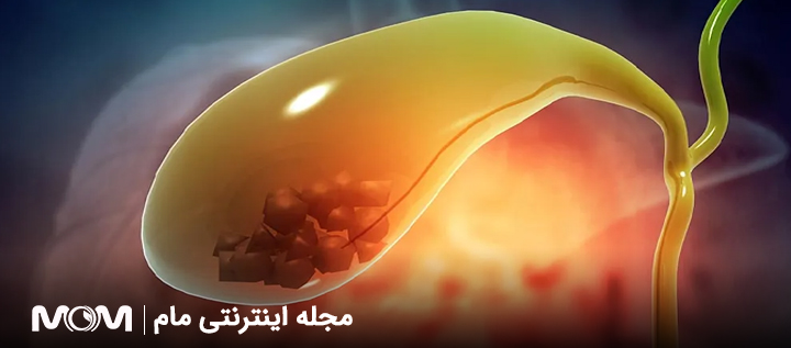 سنگ کیسه صفرا در بارداری