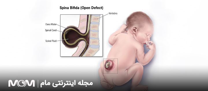 غربالگری نقایص لوله عصبی