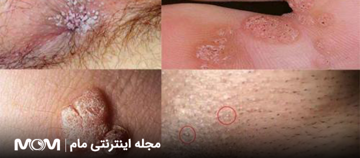 از کجا بفهمیم زگیل تناسلی داریم؟