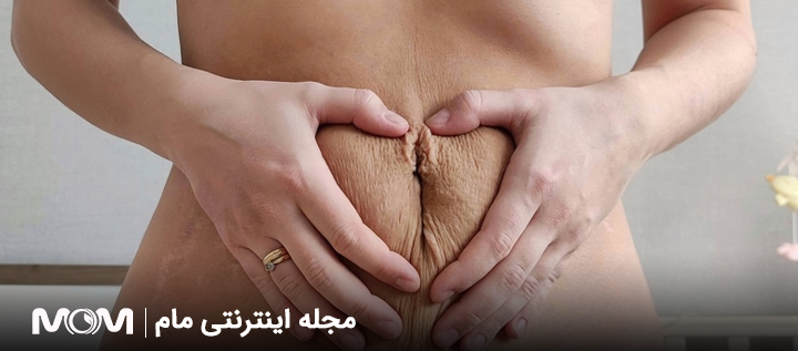 پیشگیری از افتادگی پوست بعد از زایمان