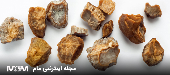 سنگ کلیه از علل درد مثانه در بارداری