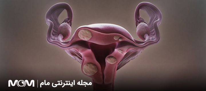 مراقبت های قبل و بعد از میومکتومی