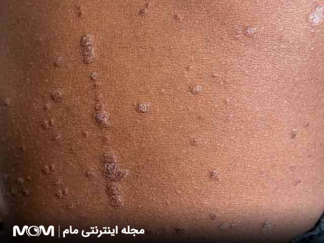 ضایعات پوستی شبیه زگیل تناسلی - لیکن پلان