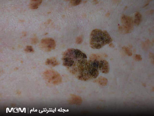 ضایعات پوستی شبیه زگیل تناسلی - کراتوز سبورئیک