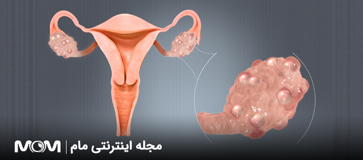 درمان تنبلی تخمدان با یوگا