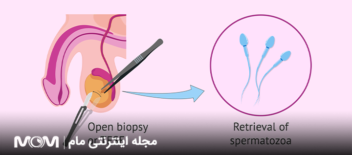 بیوپسی بیضه