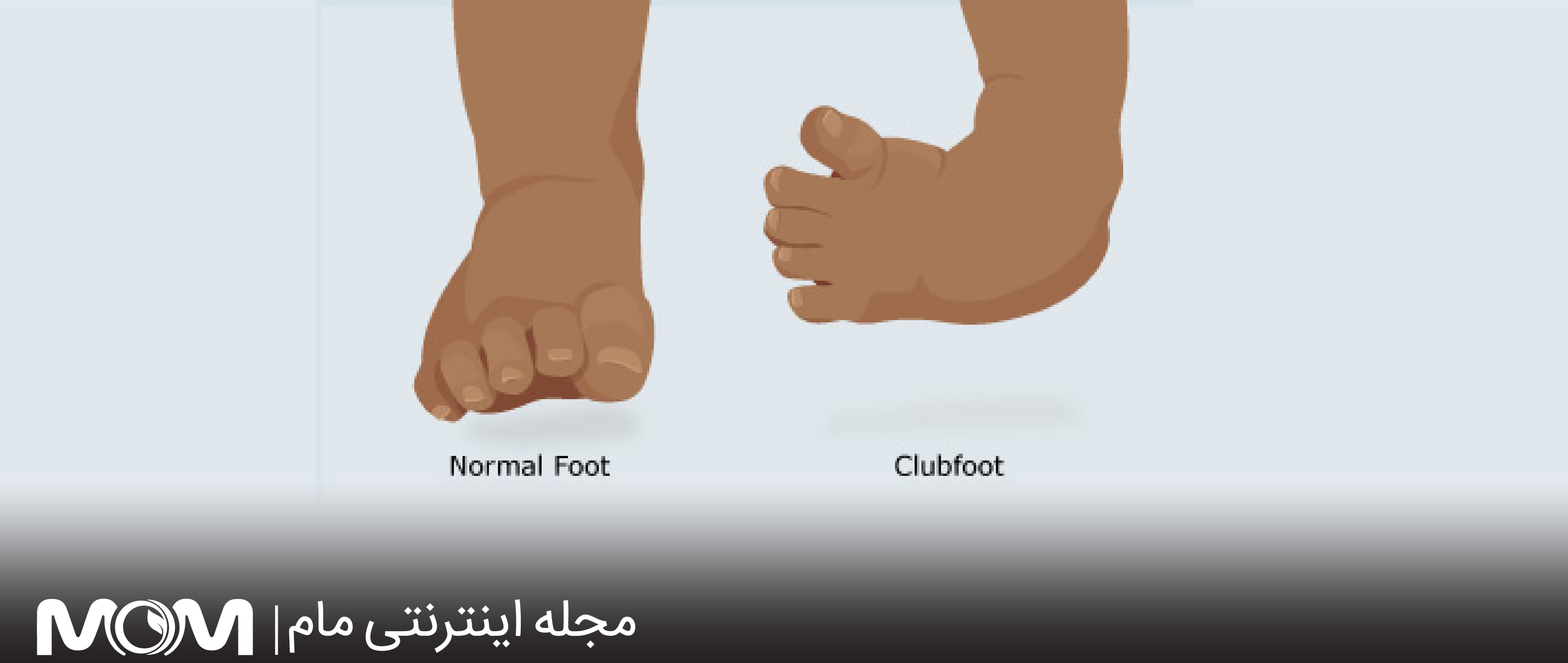 کلاب فوت در بارداری