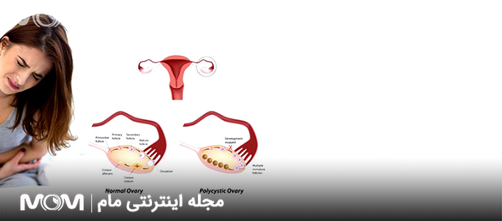علائم و علل سندرم تخمدان پلی‌کیستیک (PCOS)