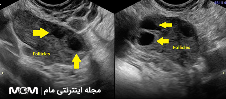 جواب سونوگرافی فولیکول در تخمدان به چه معناست؟ | تفسیر کامل و ساده
