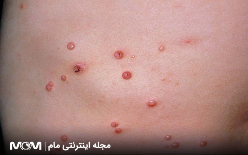 ضایعات پوستی شبیه زگیل تناسلی | مولوسکوم