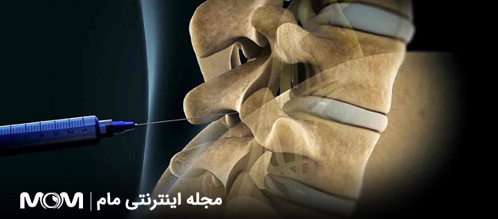 زایمان اپیدورال چیست
