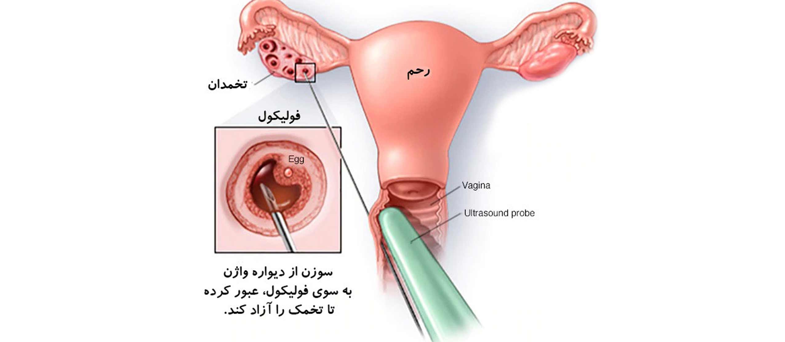 عوارض تخمک کشی | دکتر مائده احمدی