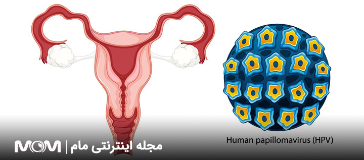 درمان زگیل تناسلی زنان