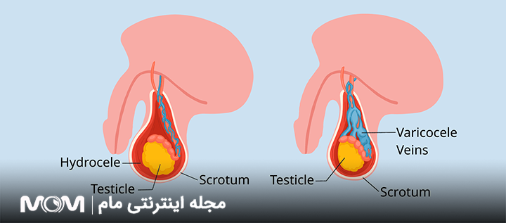 چه کسانی واریکوسل می‌گیرند؟