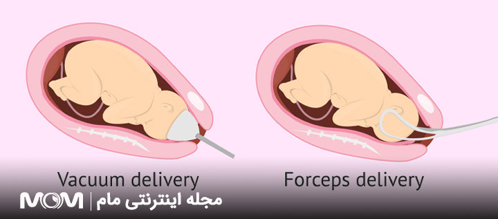 زایمان با ابزار