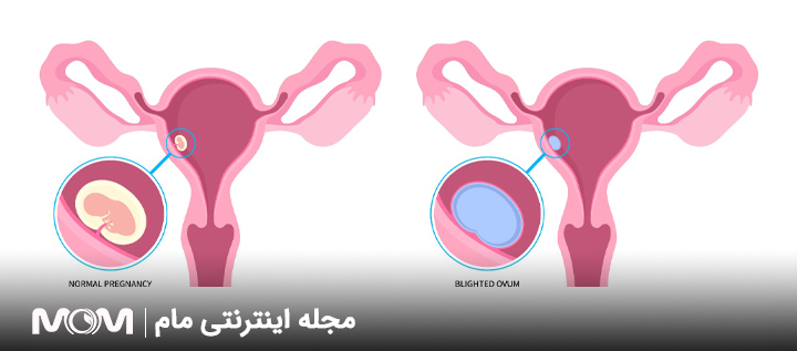 جلوگیری از بارداری پوچ